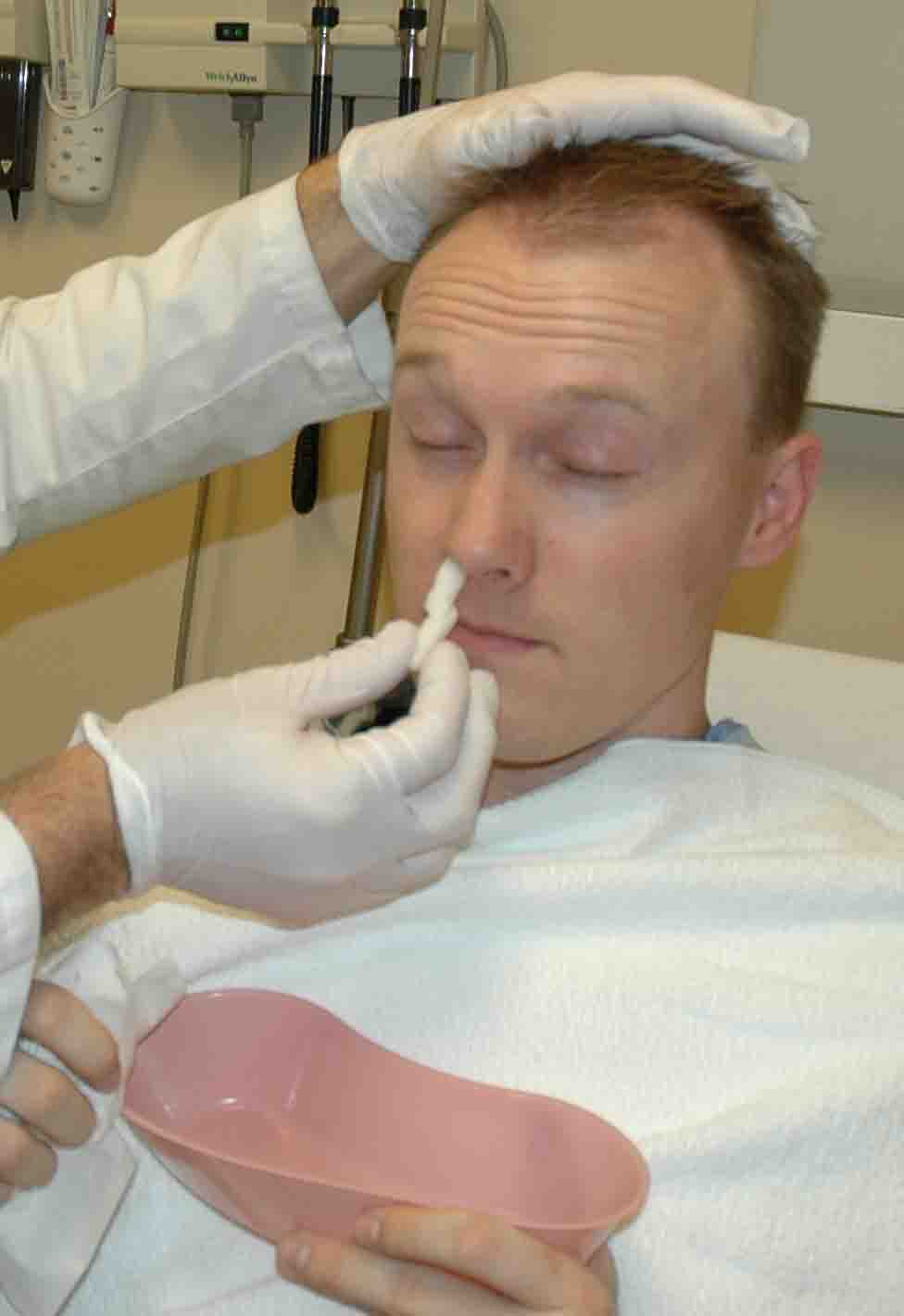 Inserting an oxymetzoline soaked cotton ball into the bleeding nostril