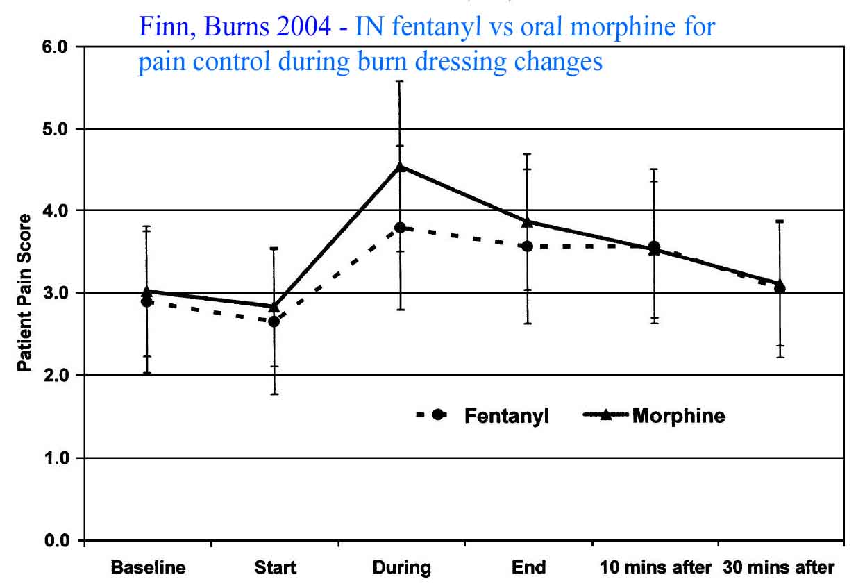 Finn literature showing pain scores in burn patients who get Intranasal fentanyl