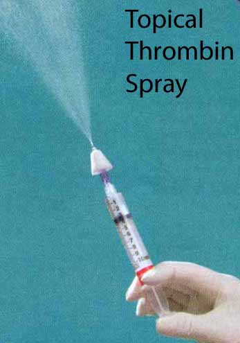 Topical Thrombin spray for epistaxis